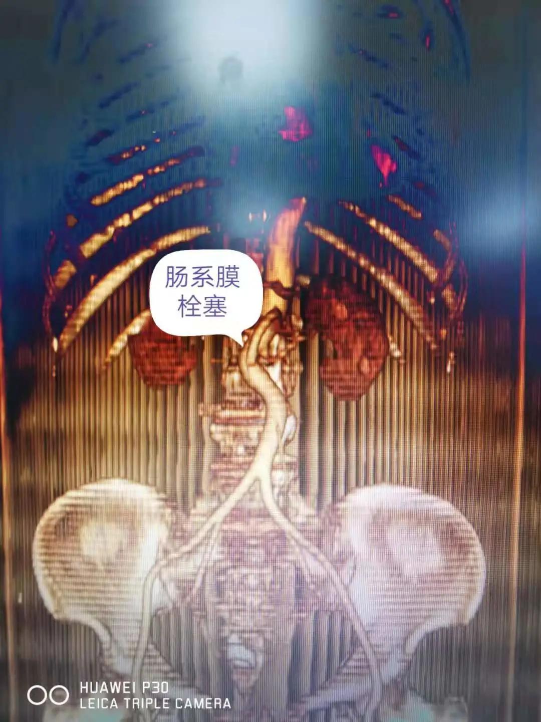 肠系膜动脉栓塞介入治疗,肠系膜下动脉栓塞介入治疗