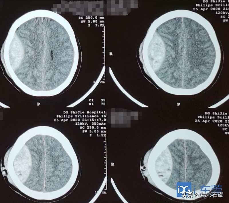 骑车摔倒脑颅出血抢救能救回来吗,骑电动车摔倒导致脑出血做完手术