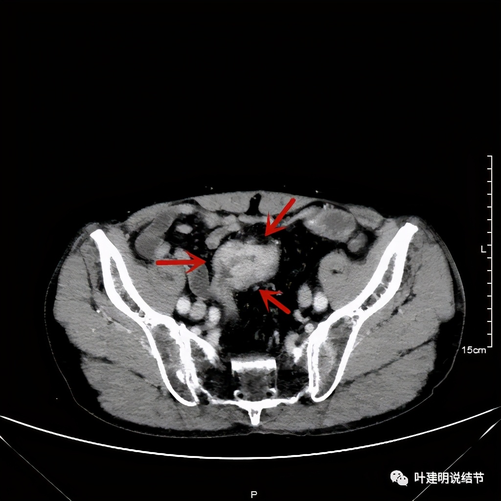 同时发现结肠癌和肺癌怎么处理,同时患结肠癌和直肠癌怎么办