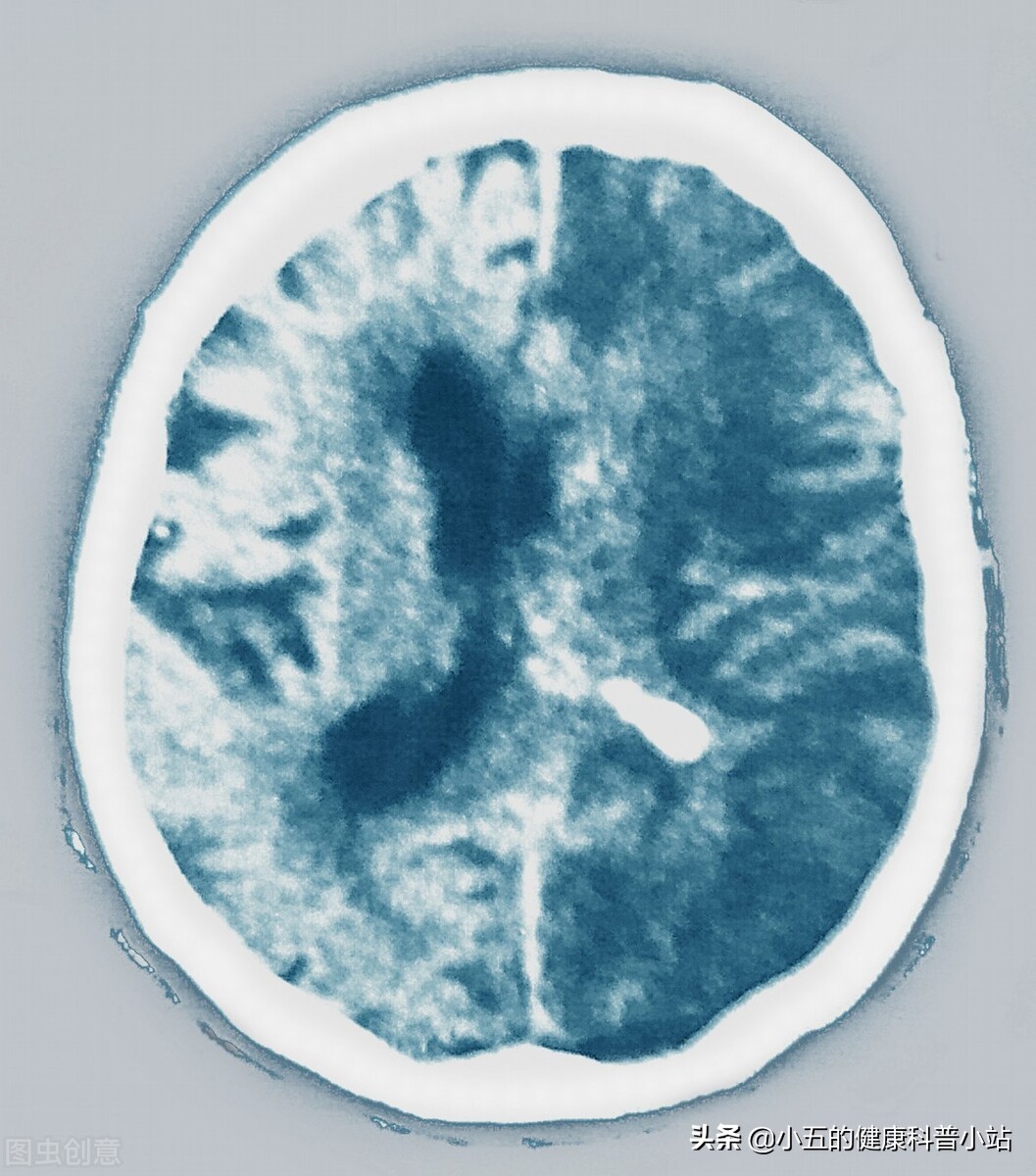 心房颤动注意事项有哪些,心房颤动日常生活有什么注意事项
