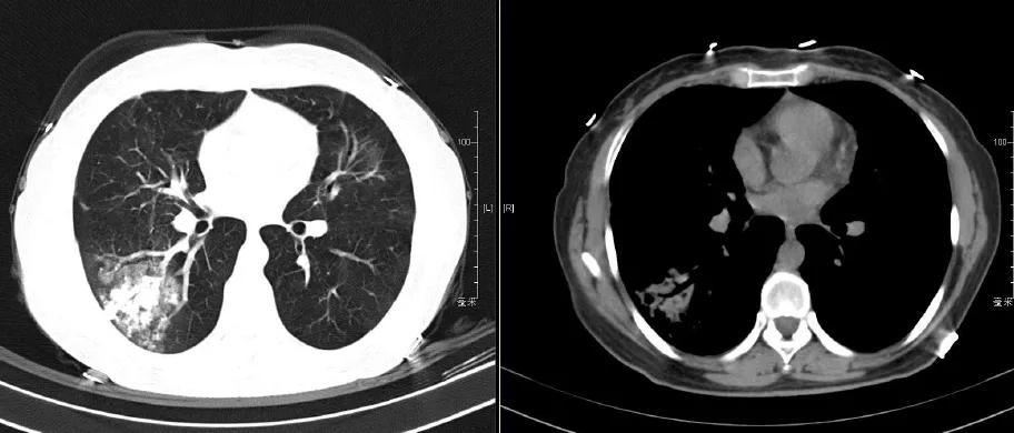 机化性肺炎必须病理确诊吗,机化性肺炎好转的征兆