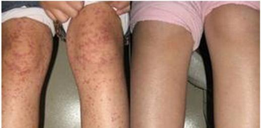 孕妇得过敏性紫癜怎么办,儿童过敏性紫癜的症状注意事项