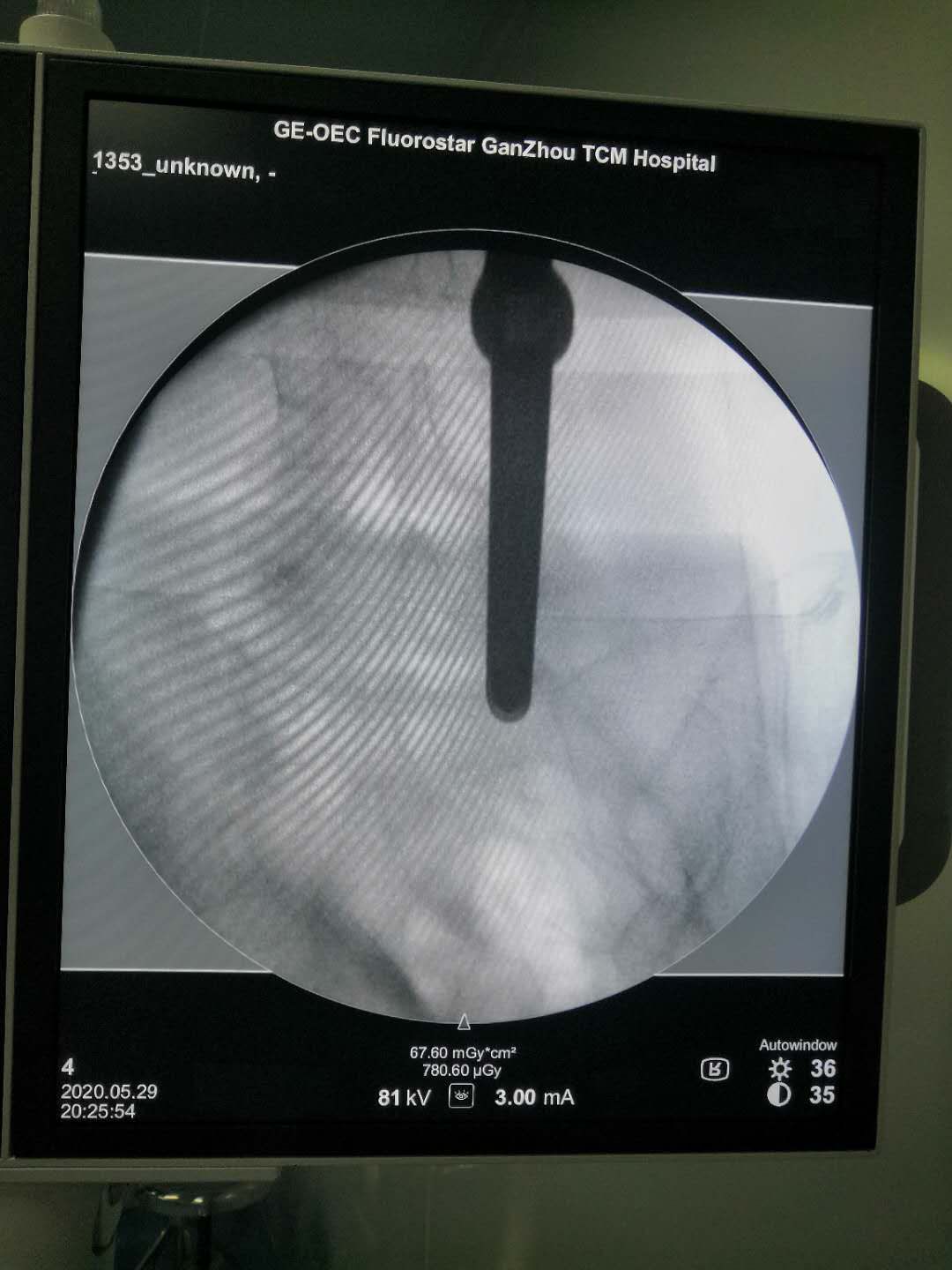 腰椎微创手术危险吗,腰椎微创手术有风险吗