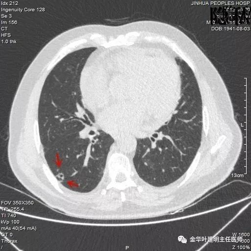 警惕-会是简单的肺大泡吗？
