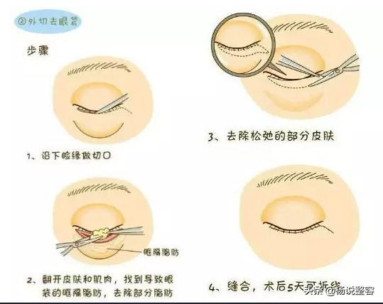 眼袋不仅难看,还特别显老,那么哪种去眼袋方法比较好呢?
