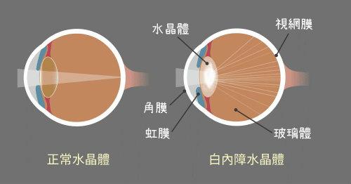 白内障爱眼日做手术免费吗,爱眼日治疗白内障哪里免费