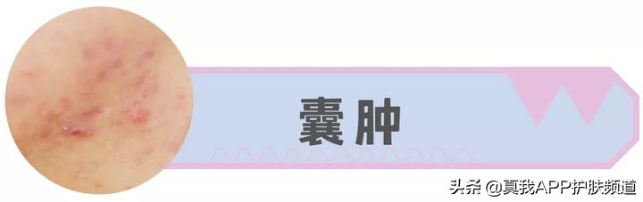 脸上长痘痘反反复复该怎么办,脸上一个部位反反复复长痘痘