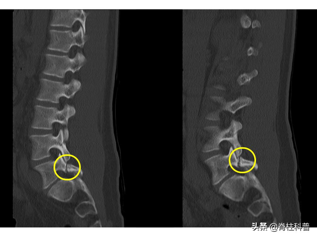 峡部裂导致滑脱有没有痊愈的可能,青少年峡部裂做哪种手术最好