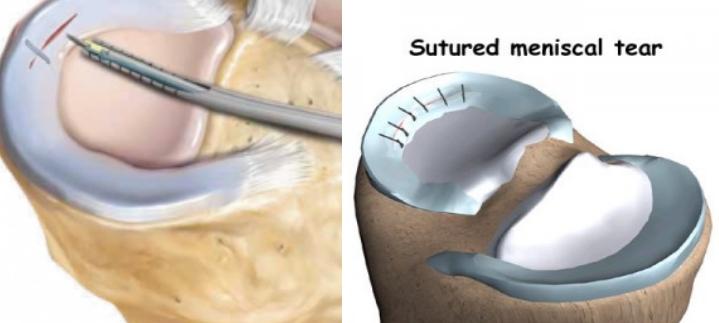 半月板损伤康复训练,半月板损伤膝盖疼的最好治疗方法