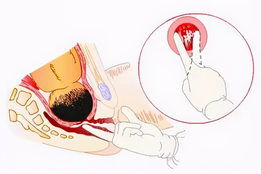 顺产开十指究竟有多大,宫口开十指是不是都能顺产