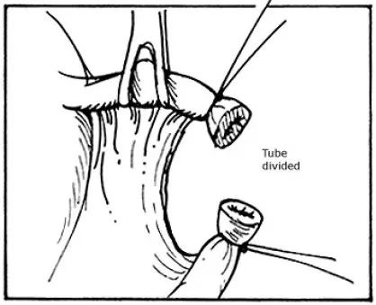 结扎精子去哪了,男士结扎后精子都去哪了