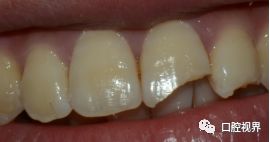 门牙折断牙根完好怎么办,门牙意外脱落怎么修复