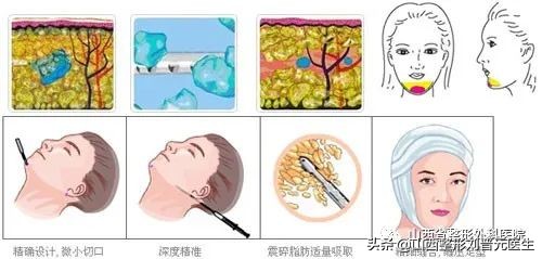 吸脂应该知道的秘密,面部吸脂真实经历视频