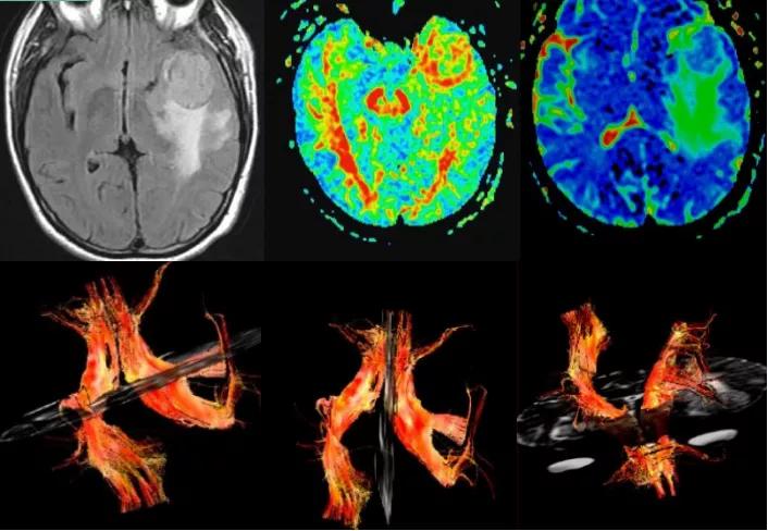 磁共振dti融合成像,磁共振dti成像作用