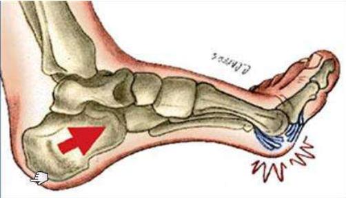 啥是草皮,啥叫草皮趾