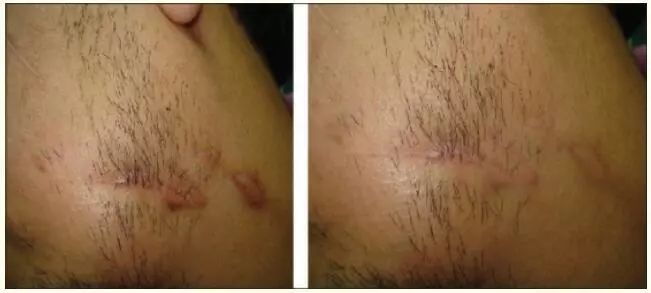 疤痕护理乳膏治疤痕可以吗,祛疤痕药有消炎效果吗