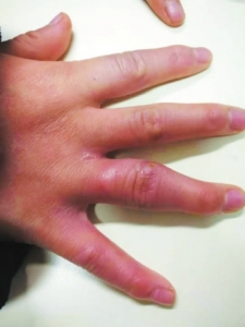 孩子腿疼莫忽视谨防骨肉瘤,儿童特发性膝关节炎症状