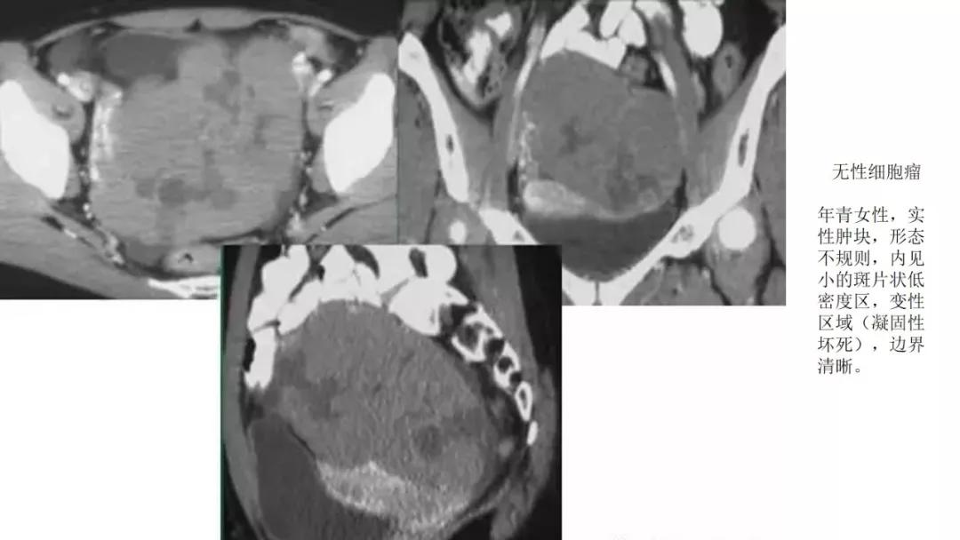 卵巢原发肿瘤的分析思路