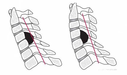 颈椎后纵韧带骨化症是颈椎病吗?该怎么办?