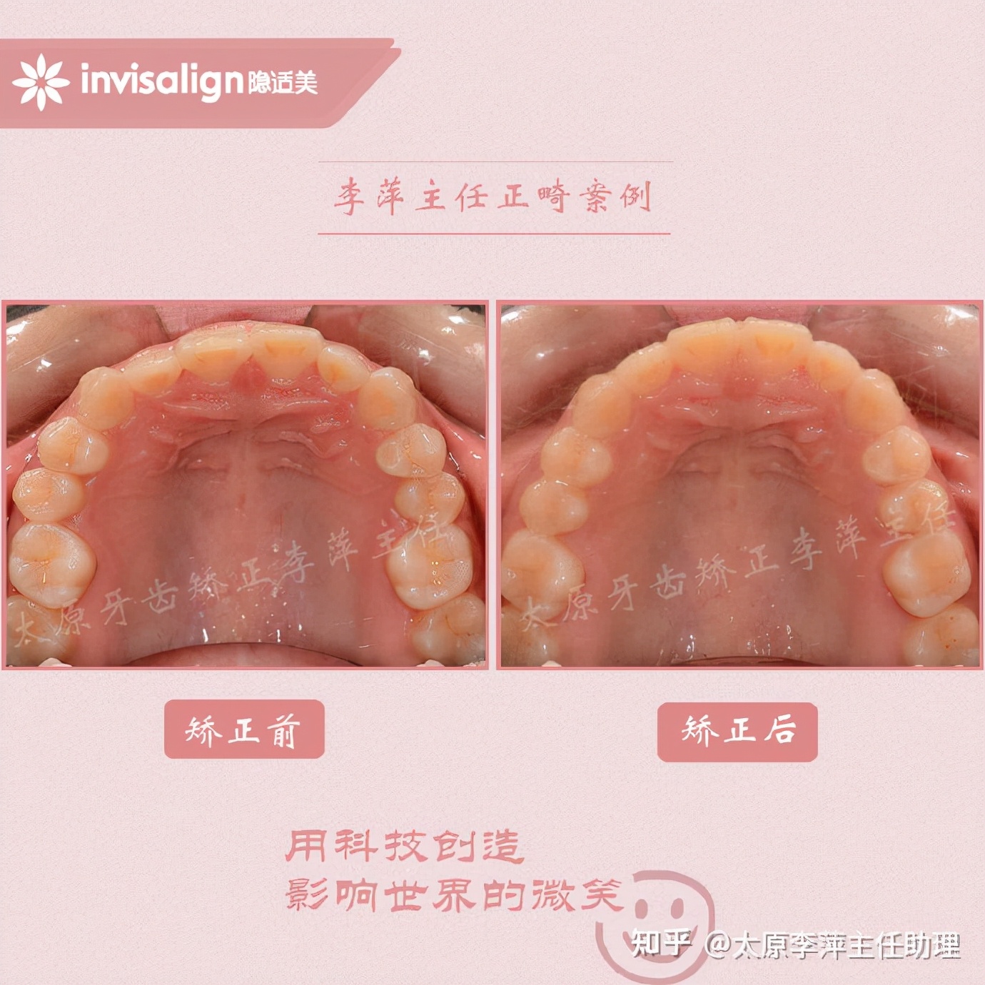 太原矫正牙齿需要做正颌吗,太原牙齿二次矫正