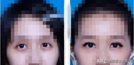 20岁眼睛凹陷是什么原因呢,眼眶会随着年龄变大凹陷
