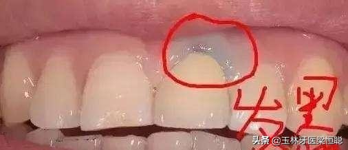 如何选择烤瓷牙牙冠,怎样选烤瓷全冠