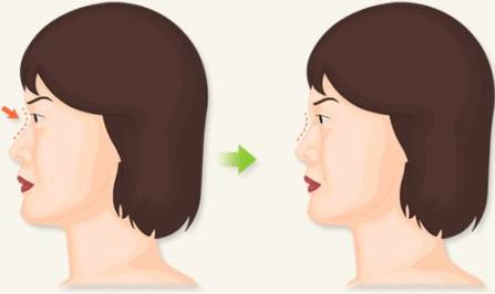 鞍鼻手术前后对比,鞍鼻矫正手术注意事项
