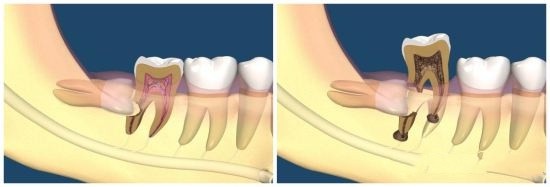 智齿到底应不应该拔,智齿到底要不要拔除
