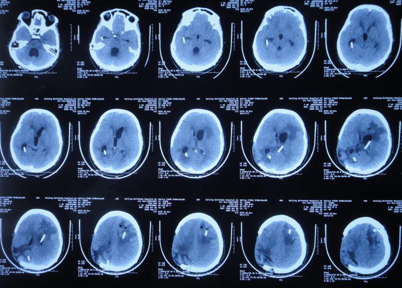 脑室有粘连脑积水有什么办法,脑动脉畸形手术后出现急性脑积水