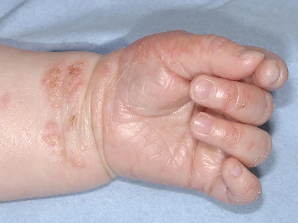 痱子和湿疹如何正确区分,怎么区分痱子和湿疹