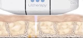 张雨绮说做超声刀就像在烤肉？我去体验了一把……