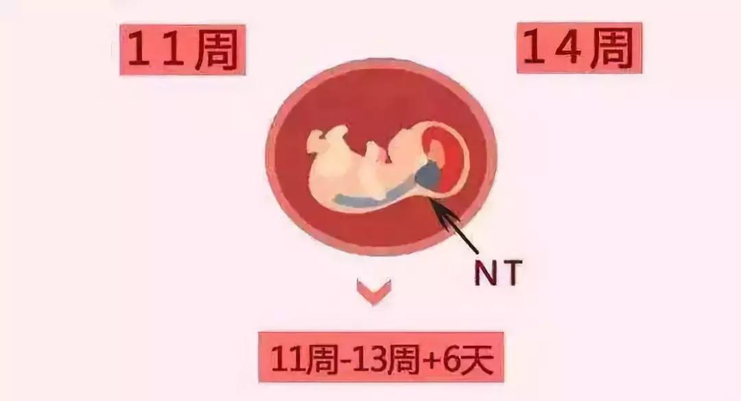 孕期nt检查前做点什么能顺利通过,nt检查孕妈侧身什么原因