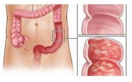 吃一次辣条会长胖吗,吃一次辣条相当于吃多少