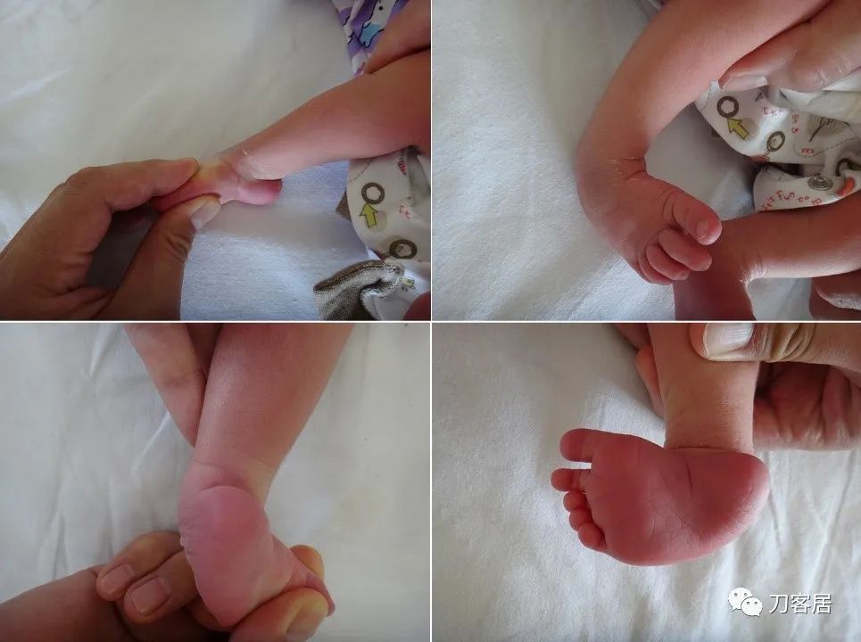 一个脊柱外科医生与马蹄内翻足的纠缠-写在6.3国际马蹄内翻足日前