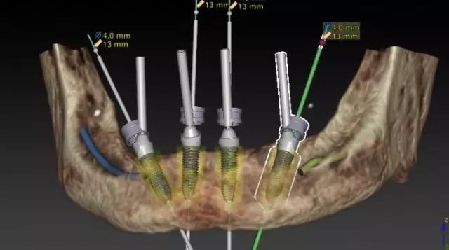 半口即刻负重种植牙过程详细步骤,即刻种植牙怎样修复牙齿的