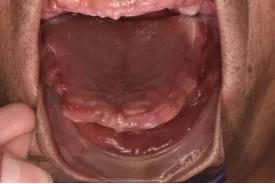 长沙牙齿种植的费用,长沙种植牙视频