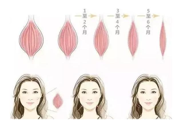 瘦脸针讲解视频,瘦脸针的原理与作用安全有效