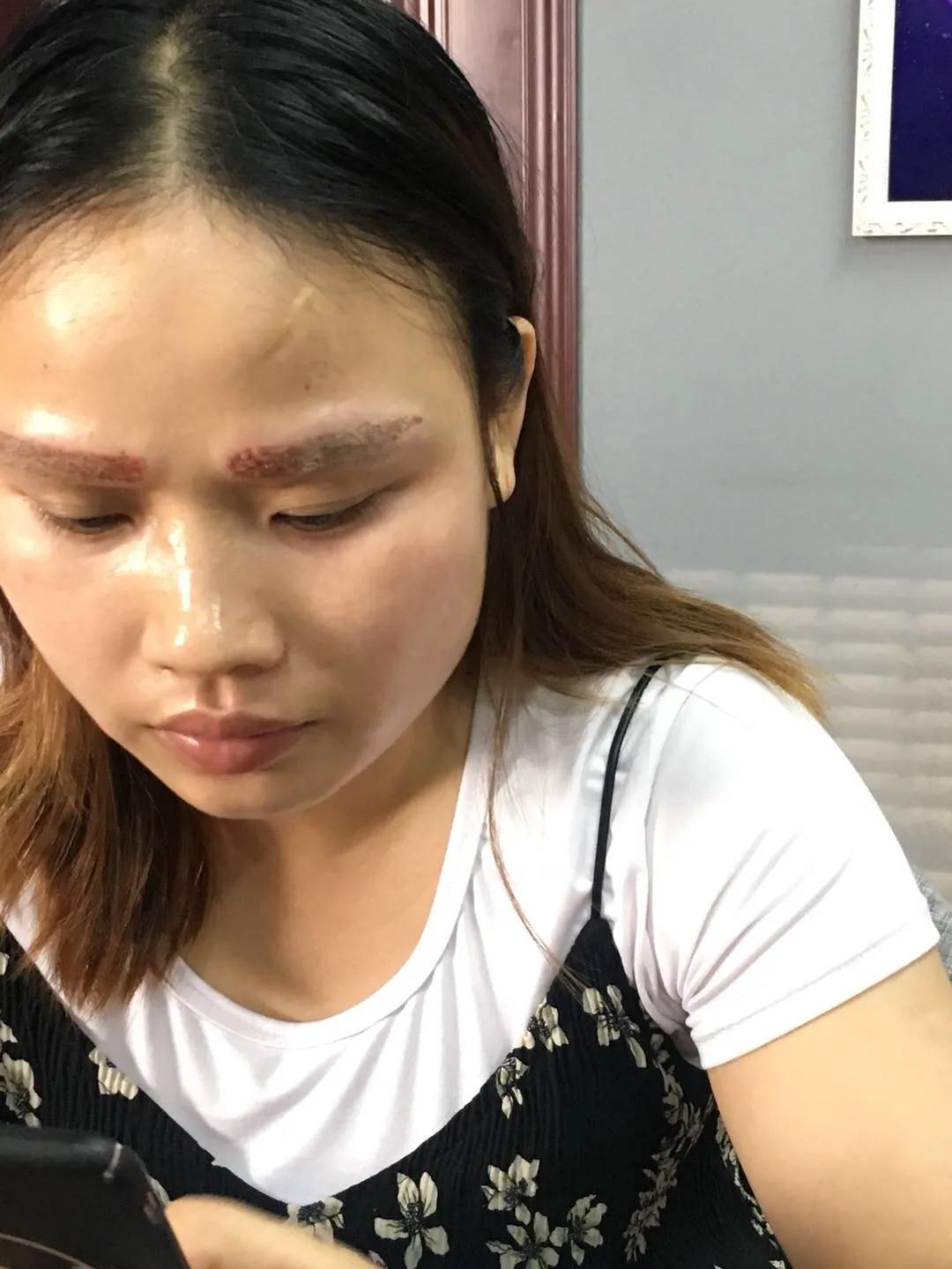 遗传性雀斑食疗方法,遗传性雀斑祛斑霜