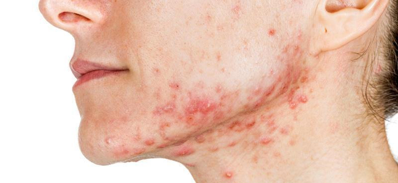 痘印痘坑消炎修复药膏,什么样的痘痘会留痘印痘坑