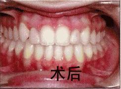 三d动画立体展示牙齿矫正全过程,3d牙齿矫正变化过程动图