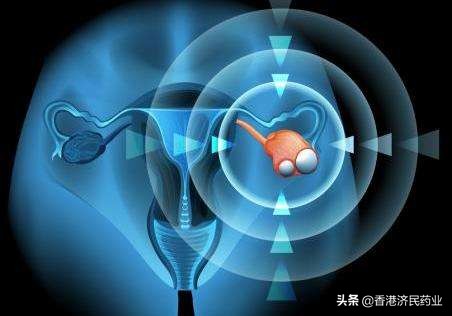 早期卵巢癌怎么筛查,女性卵巢癌早期征兆