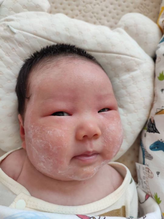 宝宝大作战8-9,宝宝湿疹大作战