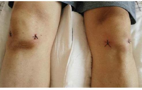 膝盖痛半月板疼怎么办缓解,膝关节疼痛半月板损伤怎么治疗