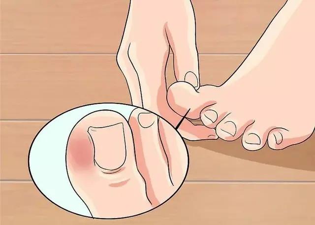 小知识一不小心扭伤脚了怎么处理,小脚趾指甲冷知识