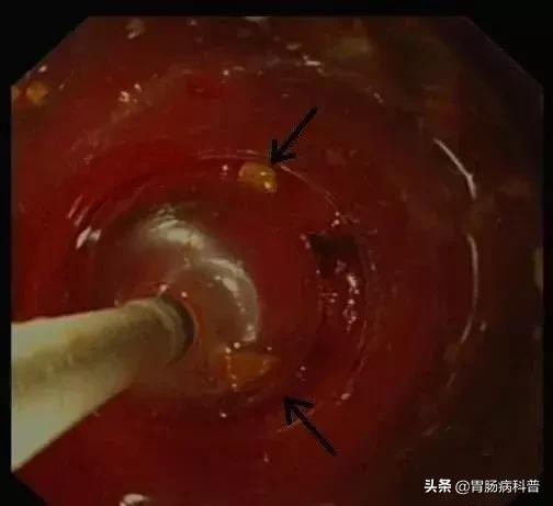 阑尾炎最新内镜微创手术,内镜下阑尾炎治疗术哪里可以做