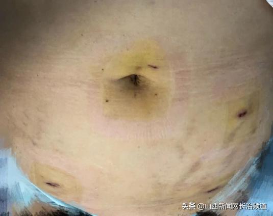 和平医院|肚脐“下刀”不留疤——和平医院开展“经脐单孔腹腔镜手术”