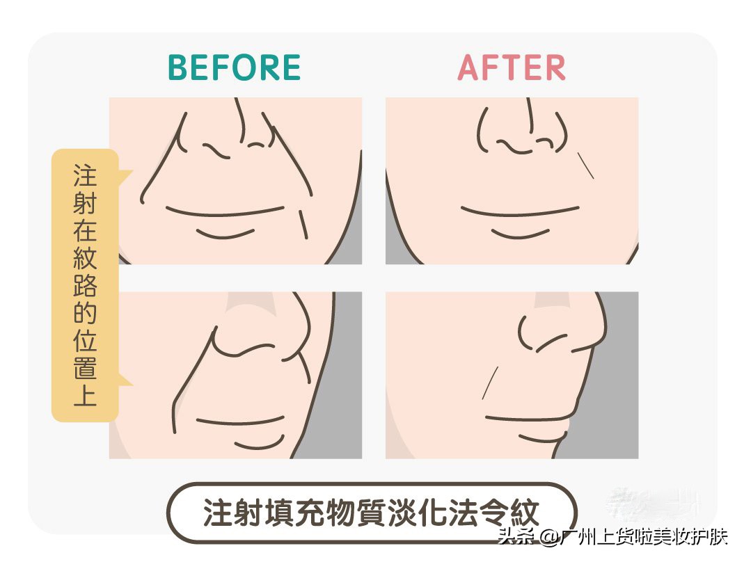 法令纹比较深最有效的办法,法令纹的种类及改善方法