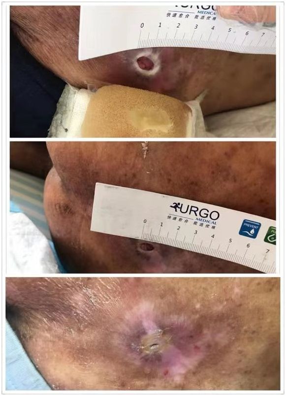 翻身起背防褥疮气垫,翻身气垫和防褥疮垫