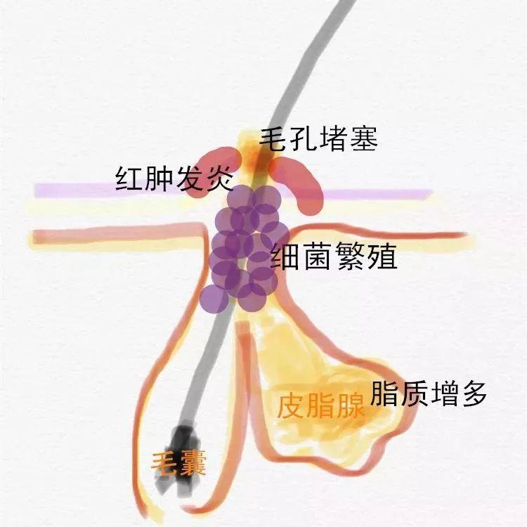 安迪总监，360°揭秘痘痘的原因