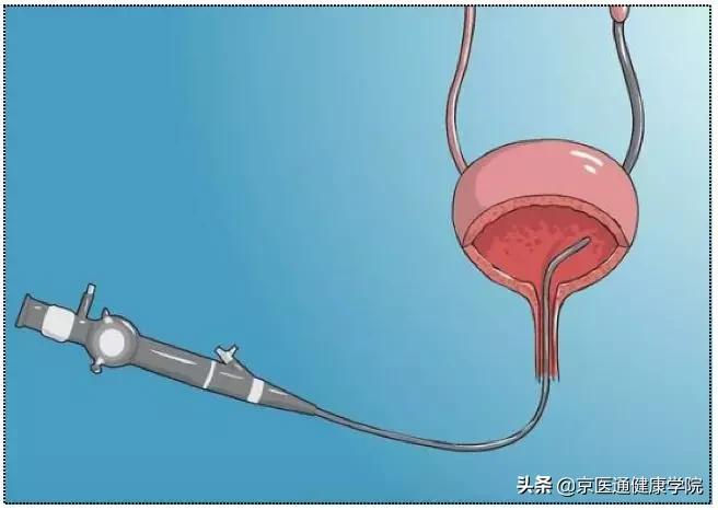 肾绞痛跟生孩子哪个痛,肾绞痛碎石怎么操作